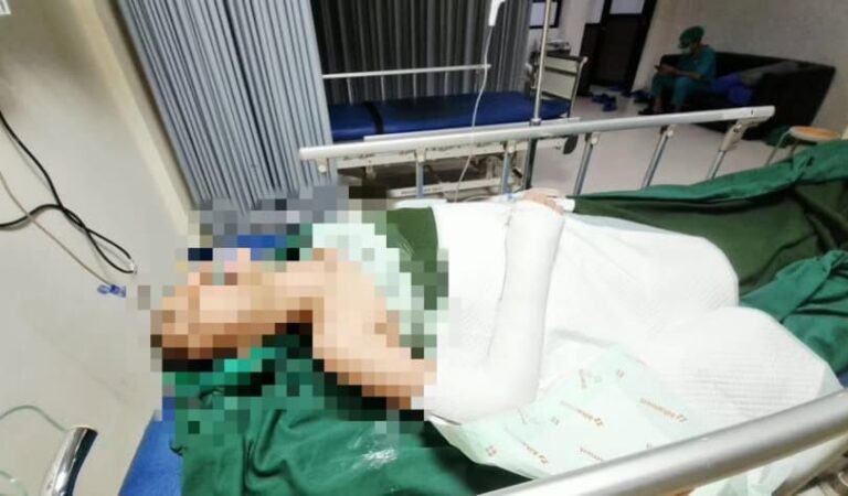 Siswi SD di Karawang Jadi Korban Perundungan Brutal, Tangan Patah dan Trauma Mendalam